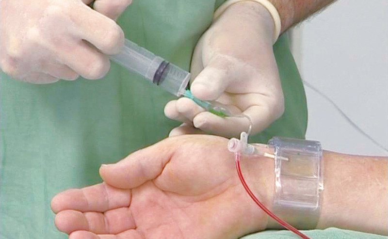 Transradial procedure (image)