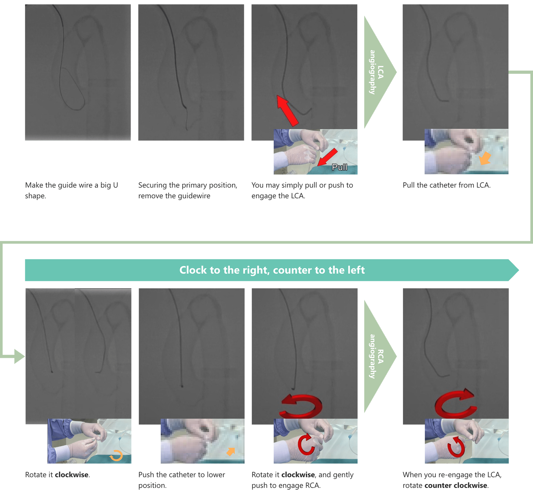 Bilateral catheter manipulation (image)