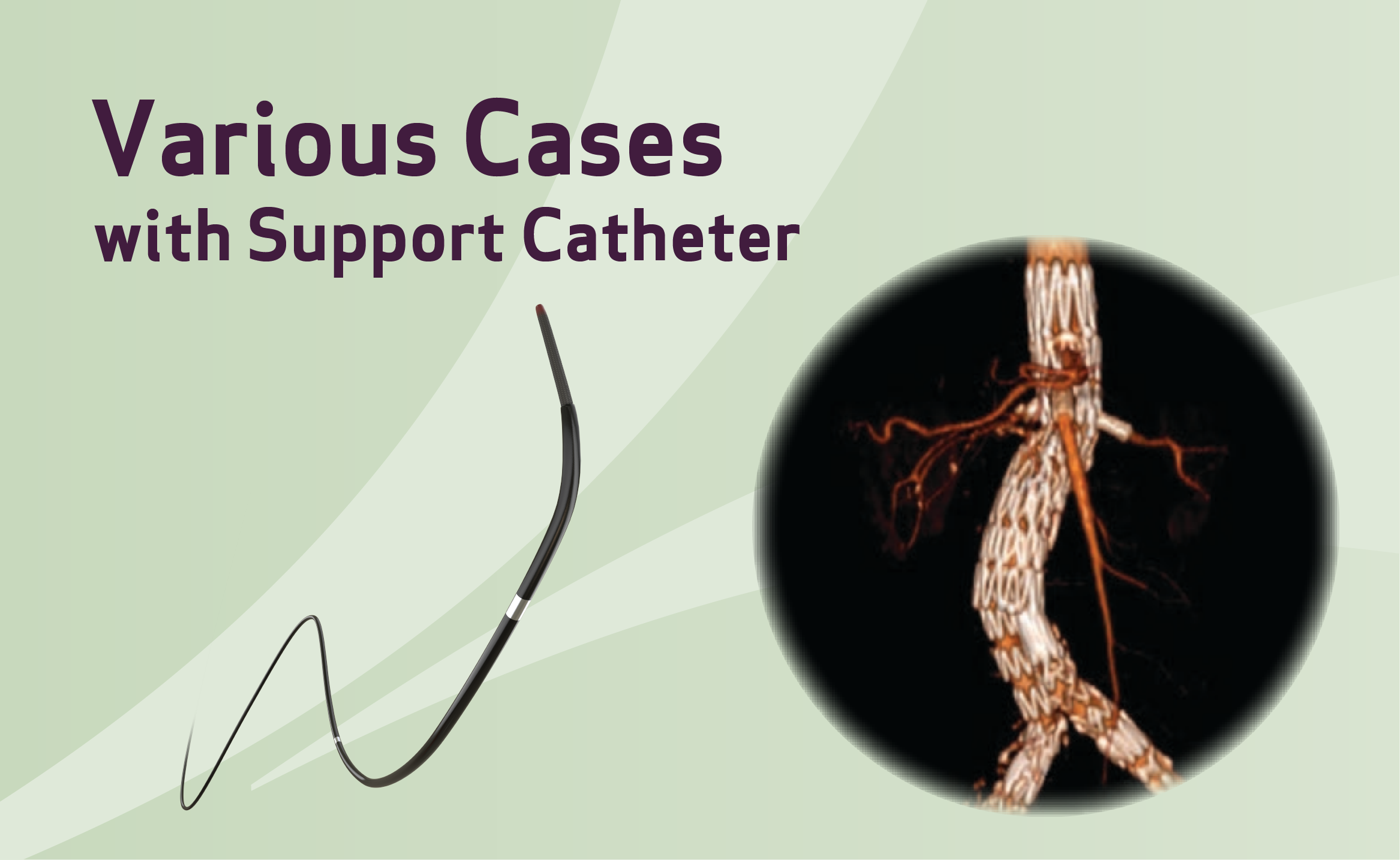 Case report of various cases with support catheter