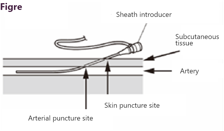 Sheath introducer (image)