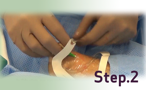 featured_radial_try_tri_sheath_insertion_tips__2_560x344