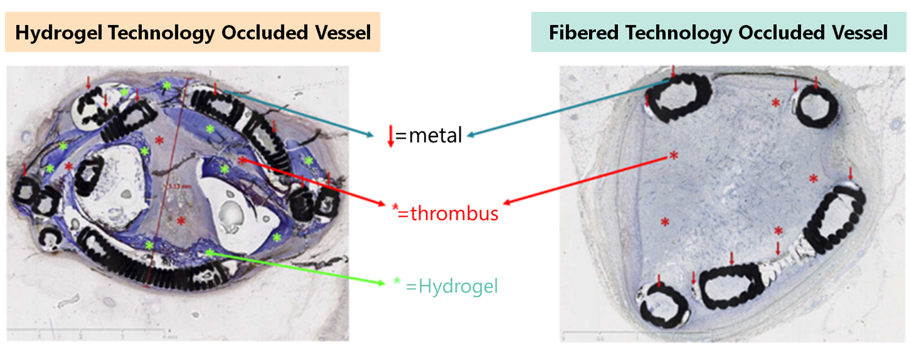 Comparison about Hydrogel and Fiberd Technology occlueded vessel (image)