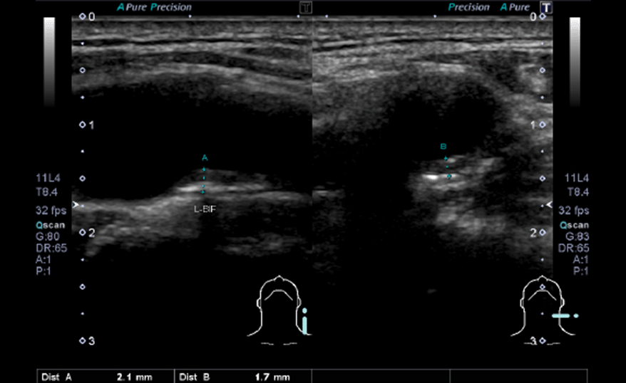 Ultrasound image (Figure2-a)
