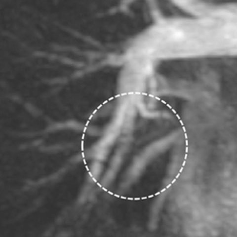 TR-MRA at 21 months after coil embolization shows no recanalization (image)