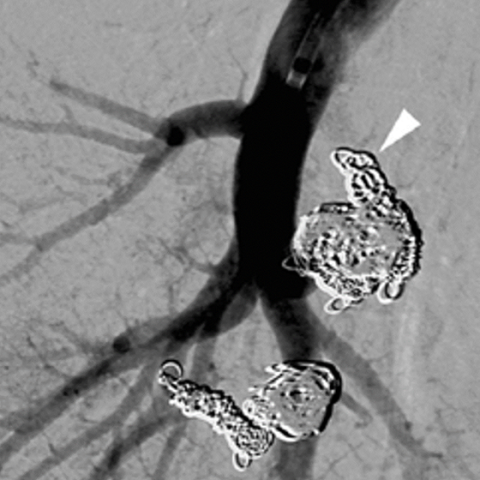 Two feeding arteries embolized using hydrogel-coated coils (image)