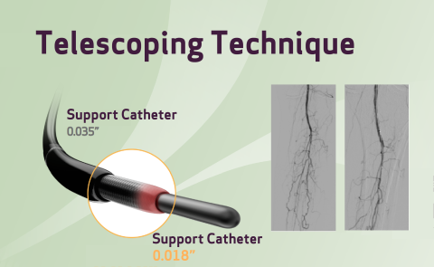 Case report of telescoping technique