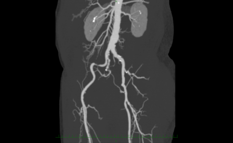 Figure.4 CT image of pre-procedure