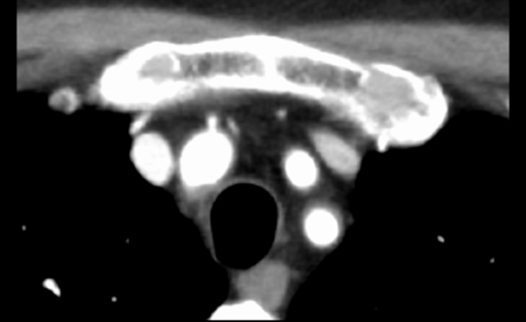 Figure.4 CT image of carotid artery