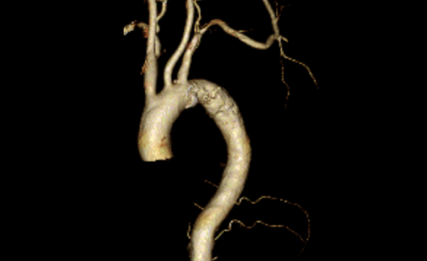 Figure.4 CT image of subclavian artery