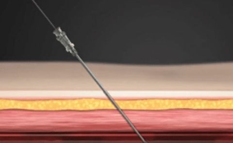 Puncture method (image)