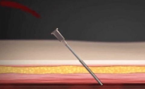 Puncture method (image)