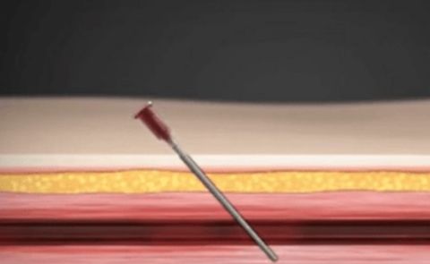 Puncture method (image)