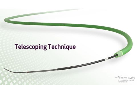 featured_tla_peripheral_telescoping_technique_880x544
