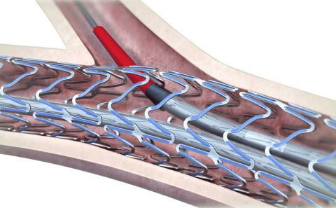 Smooth side branch access by the biggest open cell size design about Ultimaster (image)